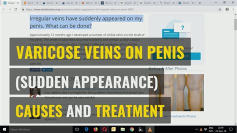 penes venosos|Veiny Penis: Causes, Symptoms to Watch For, and More.